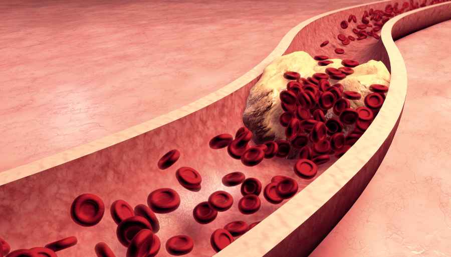 Embryonic Stem Cell Gene May Help Prevent Atherosclerosis
